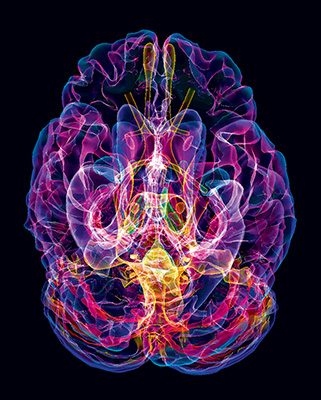 IRM 3D du cerveau d’un patient atteint de la maladie d’Alzheimer © SPL / PHANIE